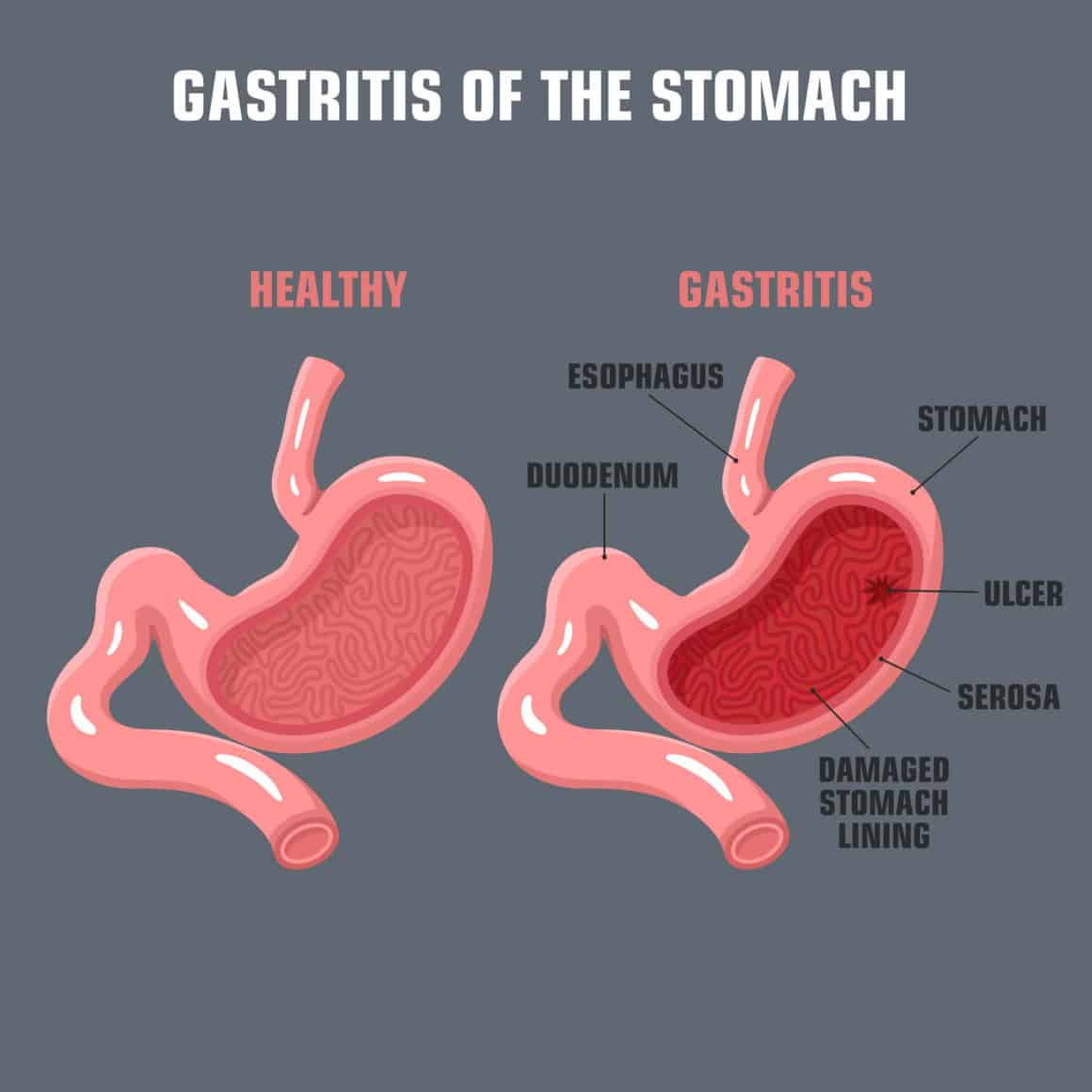 vector Science medical icon gastritis stomach. Image gastritis of stomach. Illustration stomach gastritis pathology in flat style