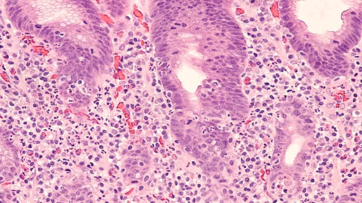 Microscopic image of an endoscopic gastric (stomach) biopsy showing chronic active gastritis (inflammation) due to Helicobacter pylori, a type of bacterial infection