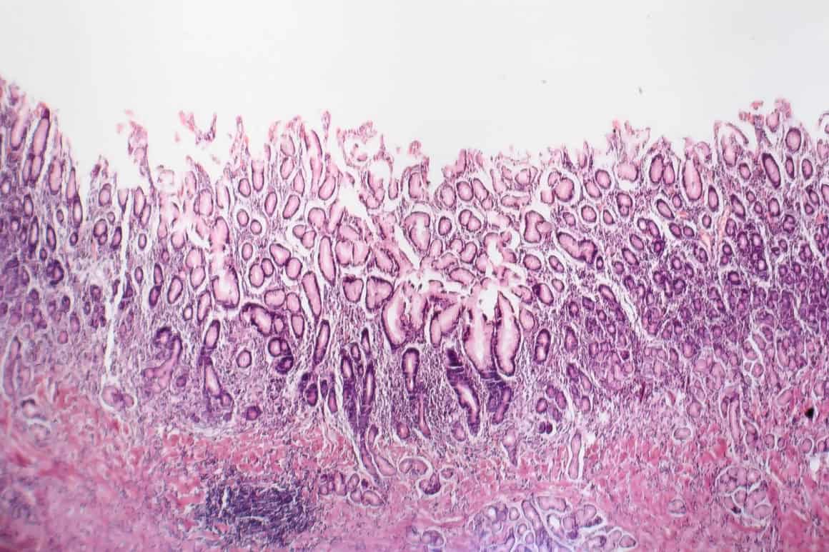 Histopathology of chronic atrophic gastritis, light micrograph, photo under microscope