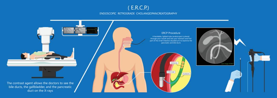 Endoscopic Retrograde Cholangiopancreatography ERCP diagnose treat device bile duct X-rays pancreatic removal material study surgery Tumor cancer infection diagnostic abdominal MRI inject