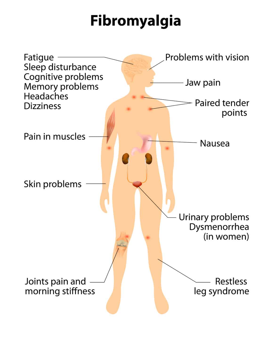 signs and symptoms of fibromyalgia. Human silhouette with internal organs