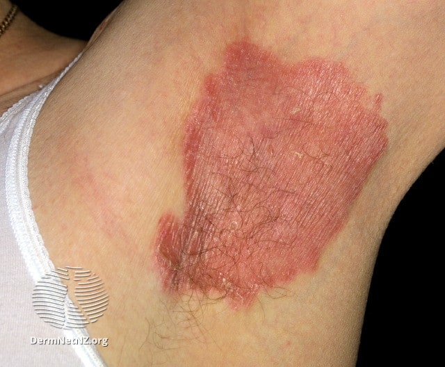 Flexural or inverse psoriasis; shiny red patch covering an armpit