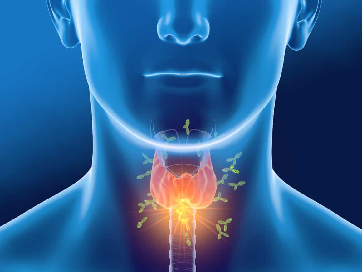 Medically 3D illustration showing antibodies attacking thyroid gland of a man. Hashimoto's thyroiditis, also known as Hashimoto’s disease or even chronic lymphocytic thyroiditis