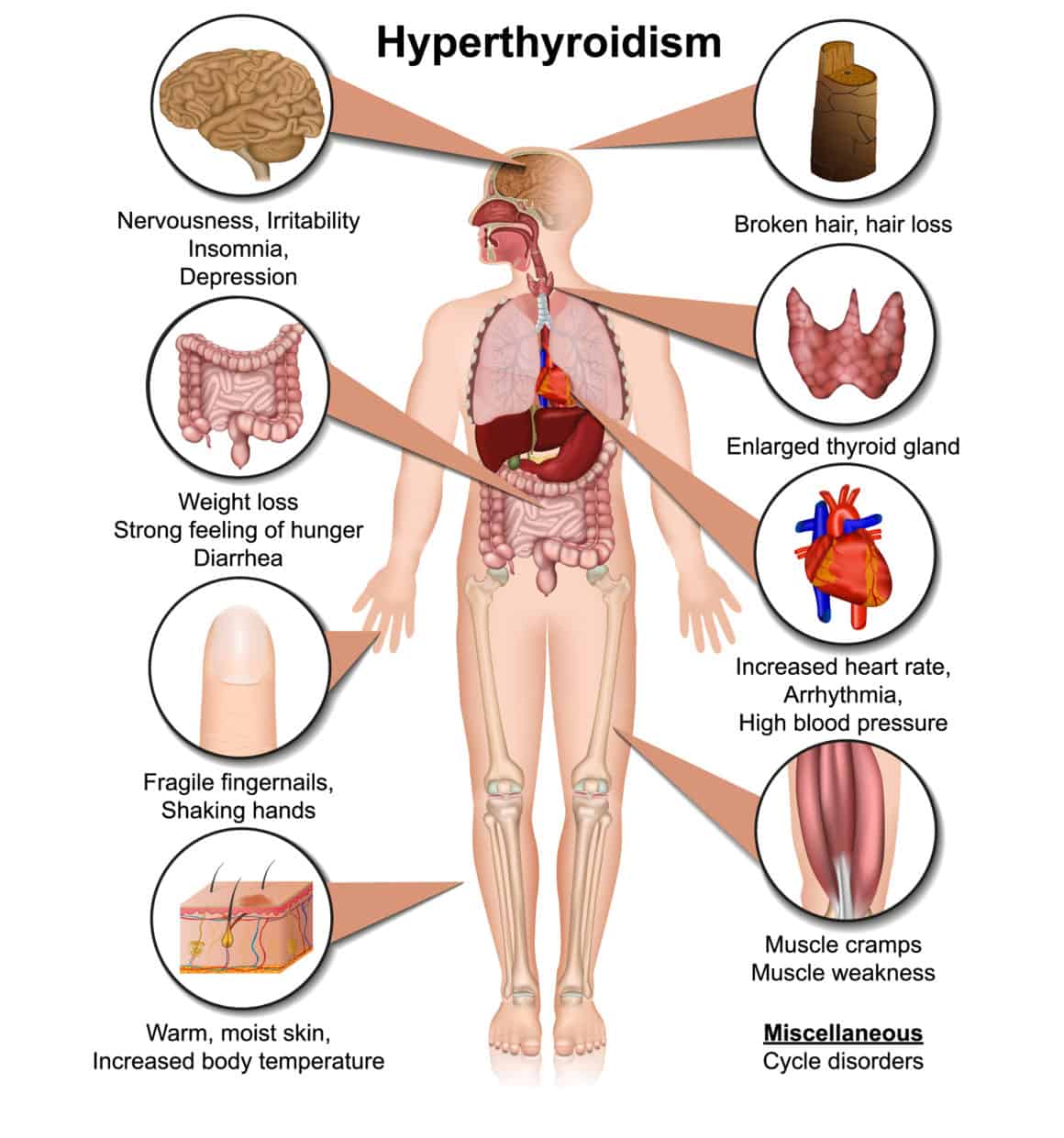 Hyperthyroidism medical vector illustration isolated on white background infographic eps 10