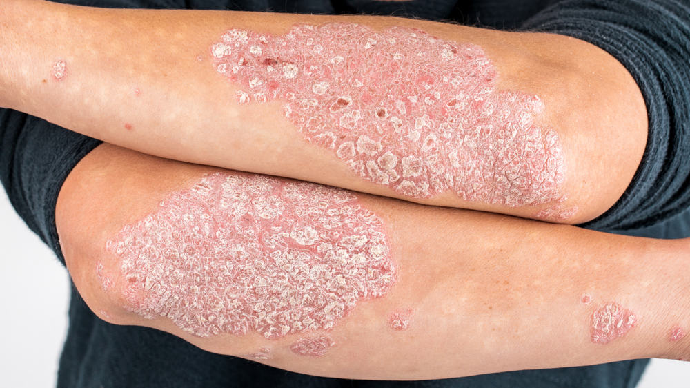 Man with scaly red and white psoriatic plaques on his elbows.