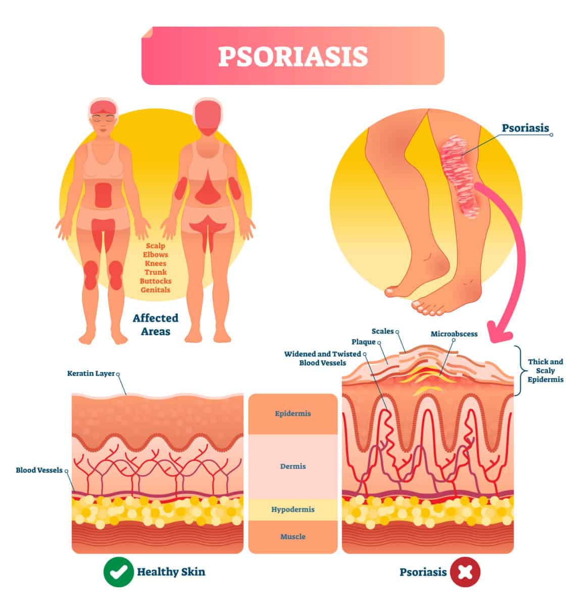 Psoriasis vector illustration. Autoimmune skin disease and illness. Labeled structure with scales, plaque, widened and twisted blood vessels. Shown affected areas on human body.