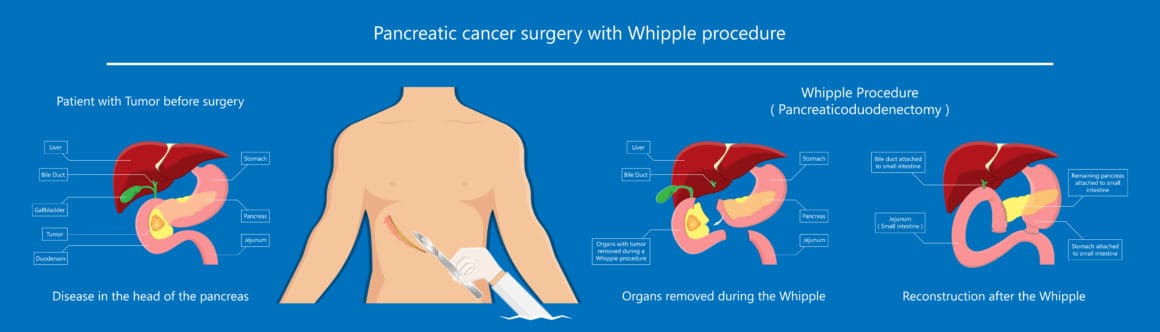 Whipple procedure pancreaticoduodenectomy Pancreatic cancer treatment total pancreatectomy Small bowel surgical