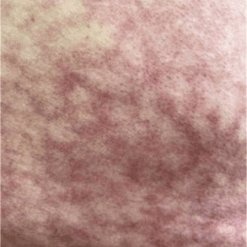Toasted Skin Syndrome Close Up