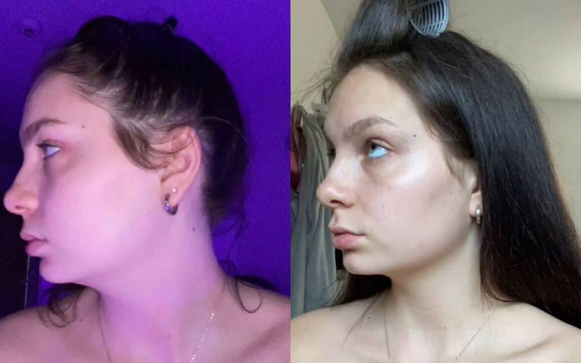 Gua Sha Before And After 6 weeks