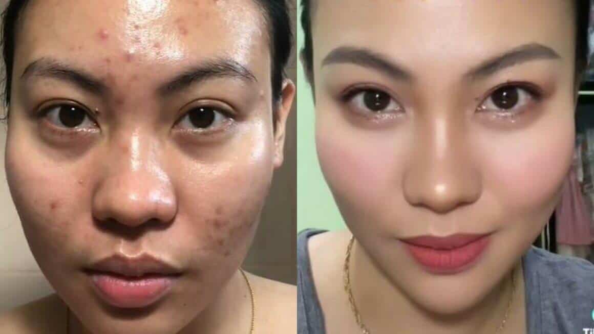 Tretinoin Before And After 4 months