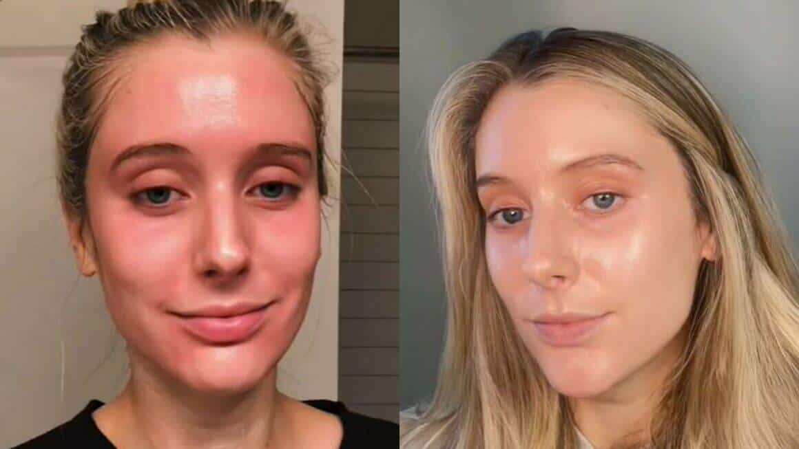 Tretinoin Before And After image