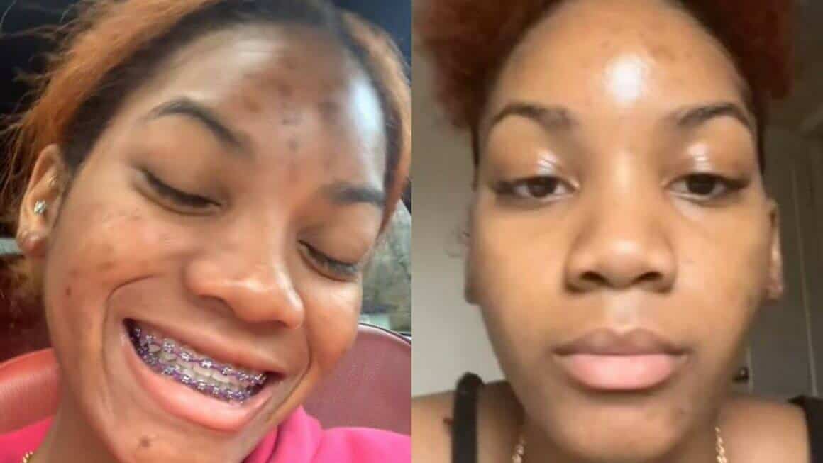 Chemical Peel Before And After 