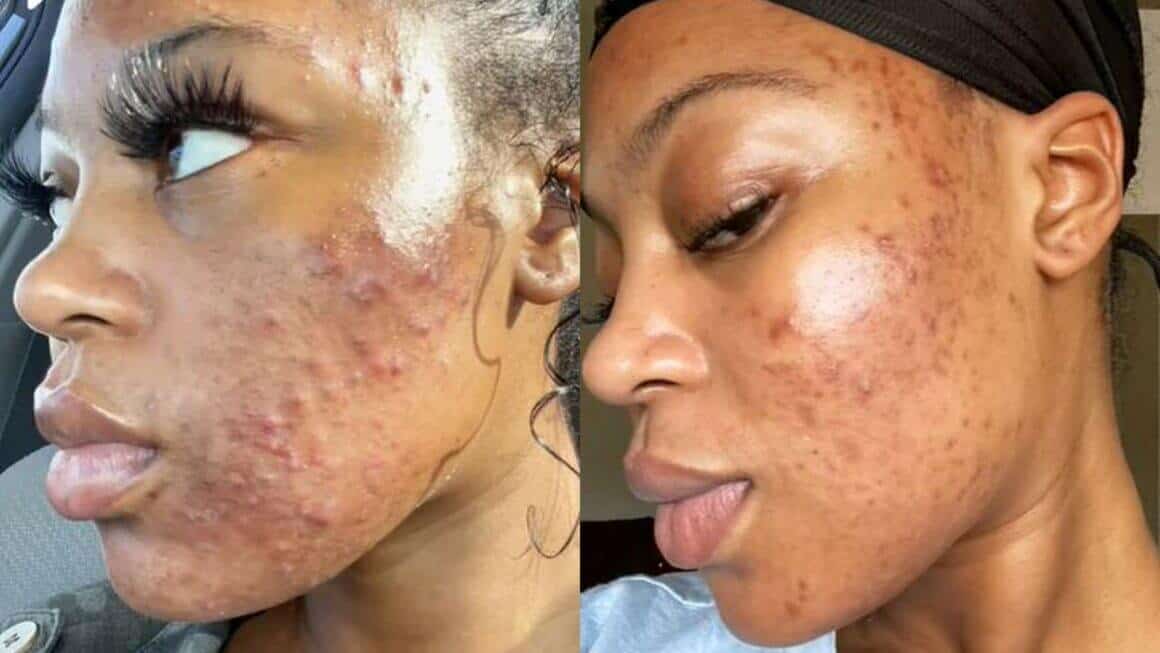 Chemical Peel Before And After image