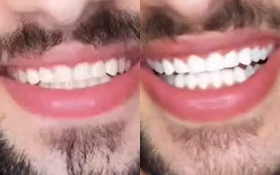 faraj before and after snow teeth whitening for one week