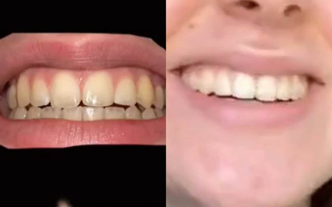 snow whitening before and after 15 days